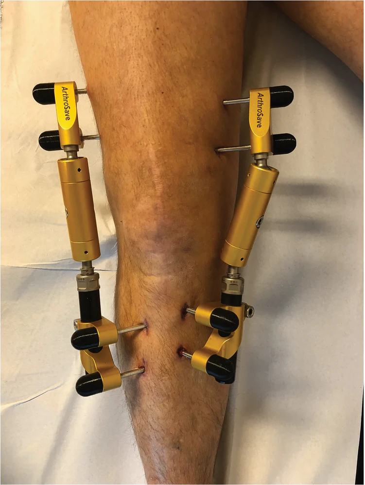 Externer Fixateur zur Gelenkdistraktion am Knie